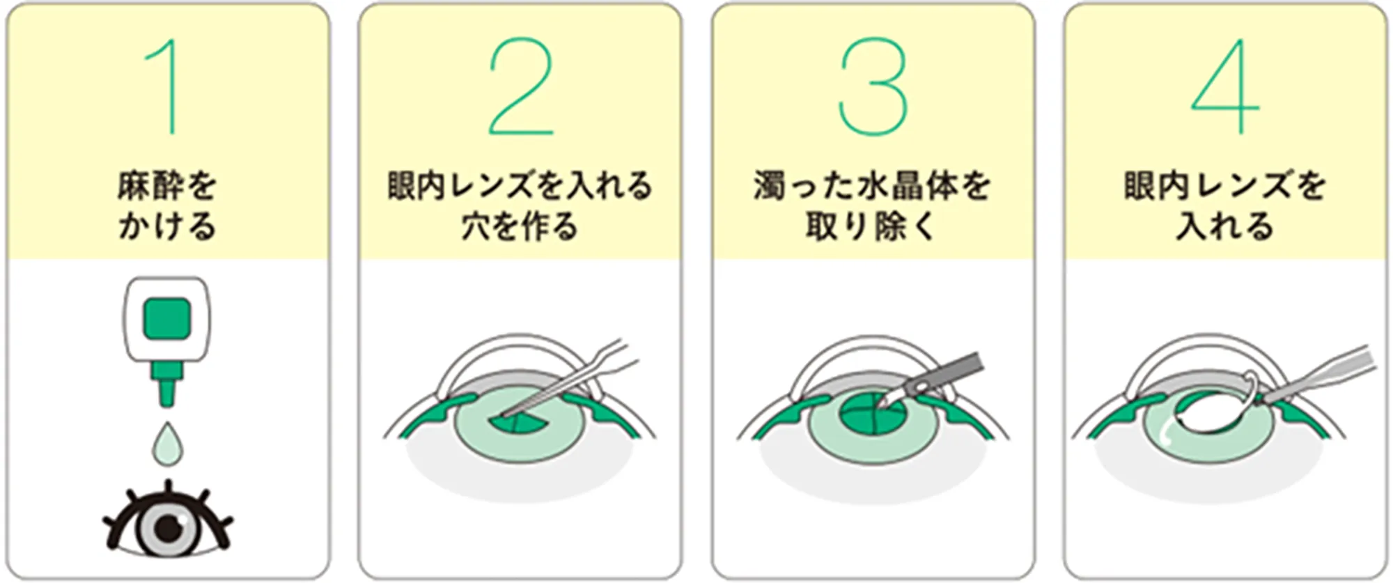 白内障手術の流れ
