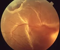 網膜剥離