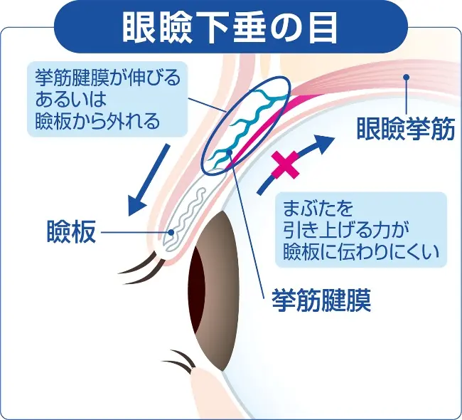 眼瞼下垂の目