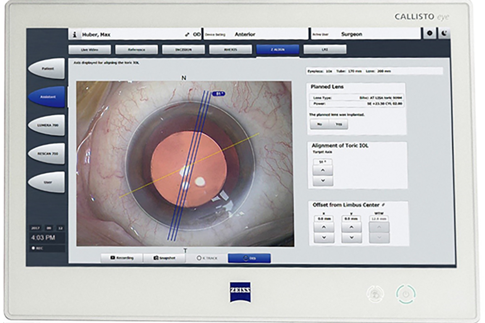 白内障手術で乱視も治せる!トーリック眼内レンズ