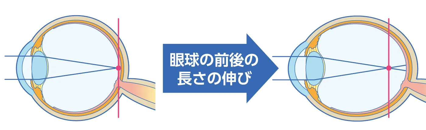 子どもの近視進行抑制治療 | 【公式】福島眼科クリニック | 東広島市の 子どもの近視進行抑制治療 | 【公式】福島眼科クリニック | 東広島市の